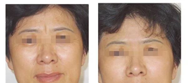 做爱贝芙去眉间纹价格