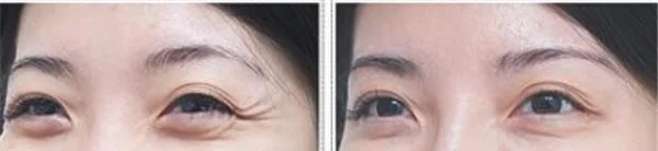 做玻尿酸去眼角细纹价格多少钱