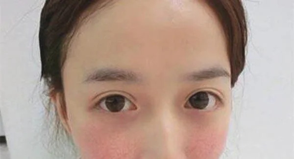 做光子祛红血丝手术注意事项是什么？