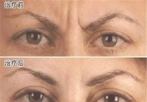 做脉冲光去眉间纹价格