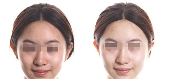 红蓝光美肤适合什么人？