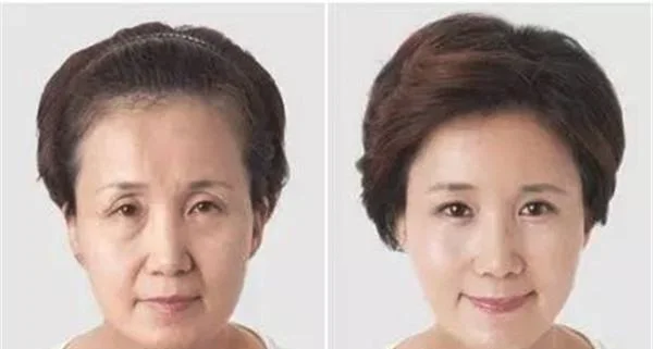 光子去法令纹不适合哪种人？