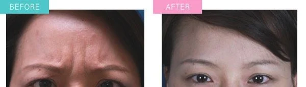 做激光除眉间纹价格