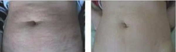 微晶去妊娠纹手术安全吗？