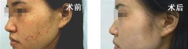 红蓝光美肤手术注意事项是什么？