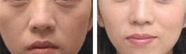 做微针嫩肤多少钱