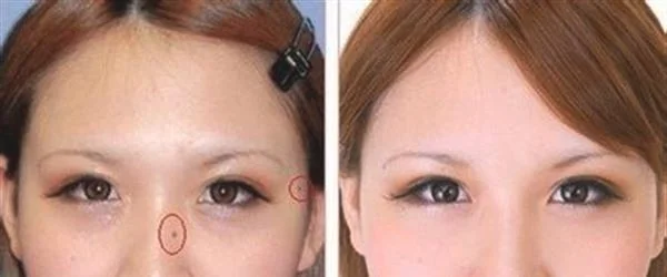 做点痣手术多少钱？