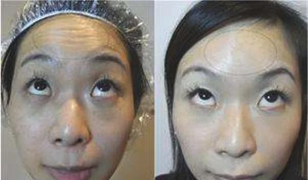 E光除抬头纹有副作用吗？