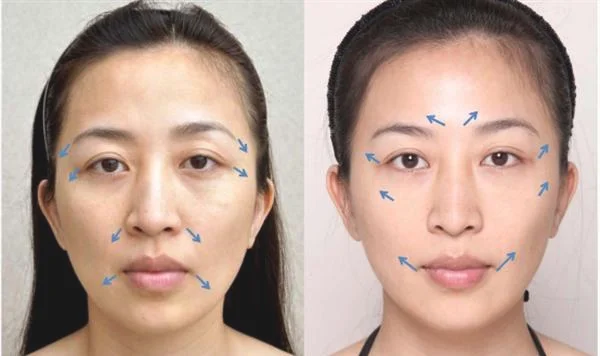 做玻尿酸去眼角细纹治疗效果怎么样？效果保持时间多久？