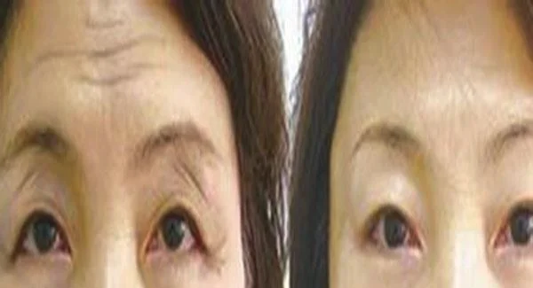 做爱贝芙去除抬头纹价格贵吗