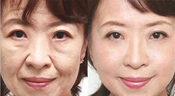 射频微针去眉间纹效果怎么样？