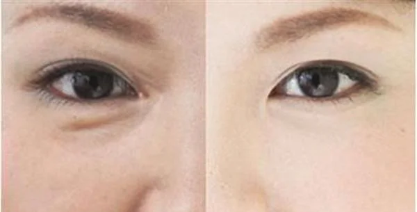 做爱贝芙去眼角细纹费用大概需要多少