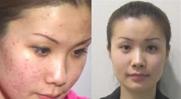 做激光去黄褐斑价格贵不贵