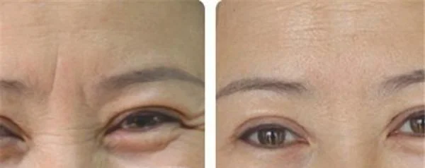 做玻尿酸去眉间纹价格