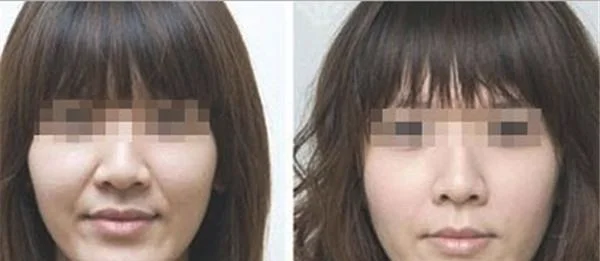 E光去法令纹不适合哪种人？