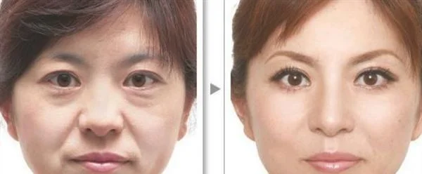 脉冲光去鱼尾纹效果怎么样？