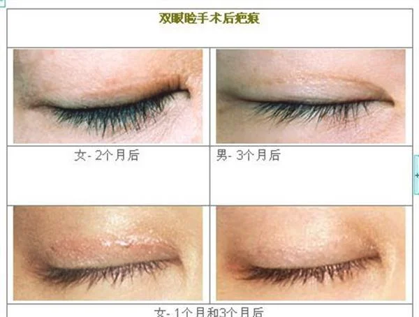 眼睑疤痕修复多久能恢复？