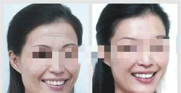 做自体脂肪去抬头纹费用多少钱