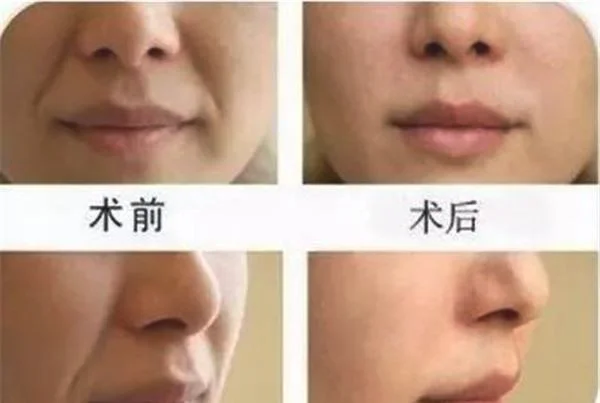 悬吊除皱去法令纹维持时间是多久？