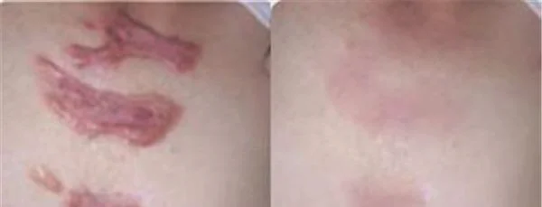 做烫伤疤痕修复价格是多少