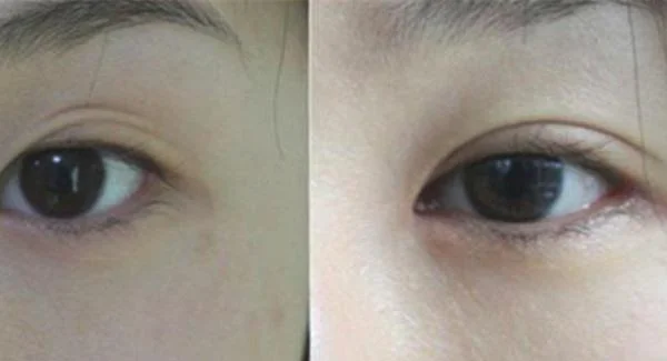 做眼睑疤痕修复手术注意事项是什么？