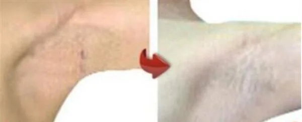做激光去腋臭价格多少钱