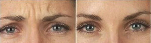 做爱贝芙去眉间纹多少钱