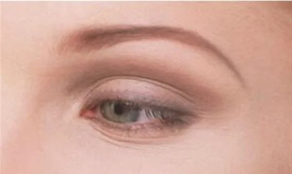 自体脂肪去眼角细纹优点是什么？