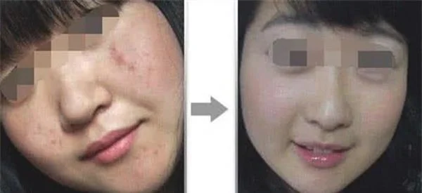 做激光去痘印治疗效果怎么样？效果保持时间多久？