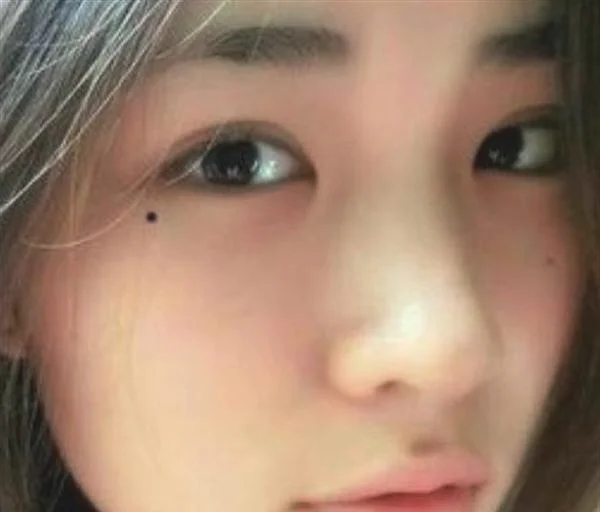 化学剥脱点痣手术术后护理？