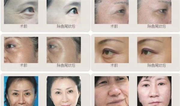 做内窥镜除皱去鱼尾纹治疗效果怎么样?效果保持时间多久?