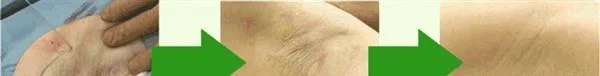 切除法去腋臭手术的方法是什么？