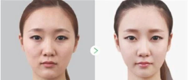做水光娃娃价格多少钱