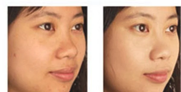 做自体脂肪去痘疤价格