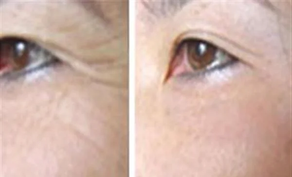 做脉冲光去眉间纹价格要多少