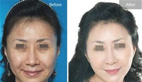 微晶磨皮去眉间纹不适合哪种人？