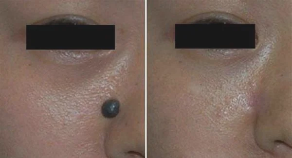 做剥脱治疗去雀斑手术多少钱？