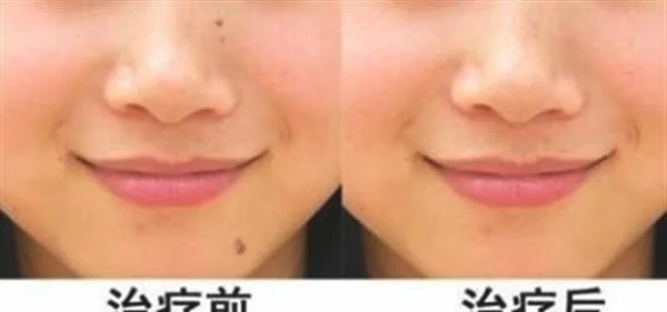脸上有痣怎么去掉