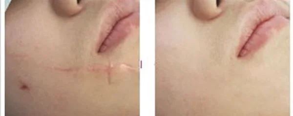 烫伤疤痕修复有哪些优点?