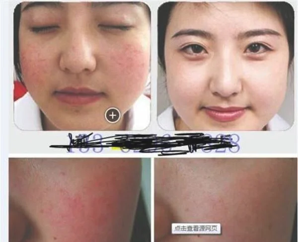 做E光去红血丝手术多少钱？