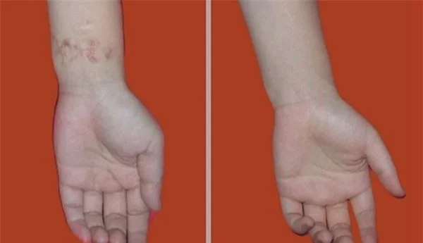 做烧伤疤痕修复价格