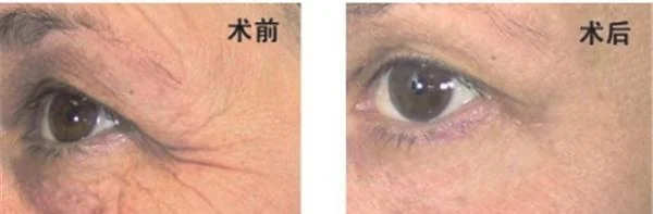 小切口除皱去鱼尾纹需要注意什么？