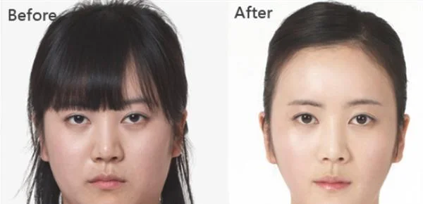 做冷冻治疗去痘疤治疗效果怎么样？效果保持时间多久？