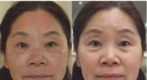 做射频祛斑治疗效果怎么样？效果保持时间多久？