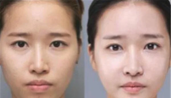 彩光嫩肤有什么缺点?