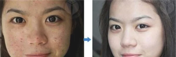 做脉冲光去痘印价格多少钱