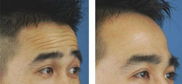 爱贝芙去除抬头纹要多少钱?