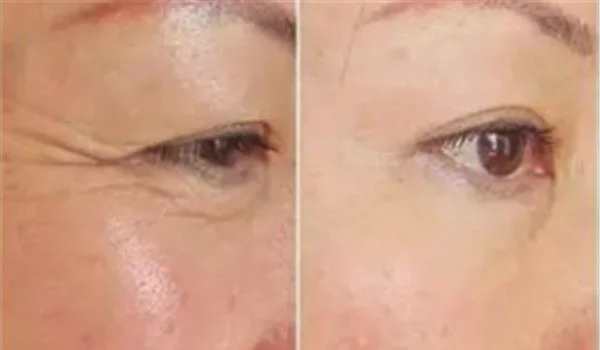 自体脂肪去鱼尾纹需要注意什么?