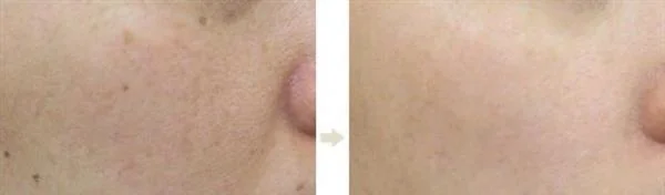 做光子去黑痣多少钱