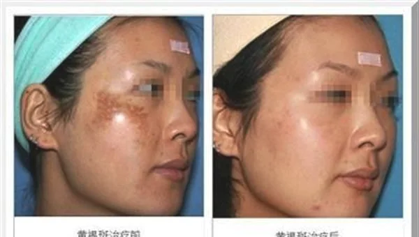 冷冻法去黄褐斑手术效果好不好？